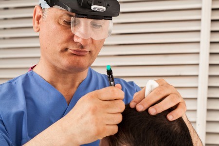 زراعة الشعر الايطالي في القاهرة