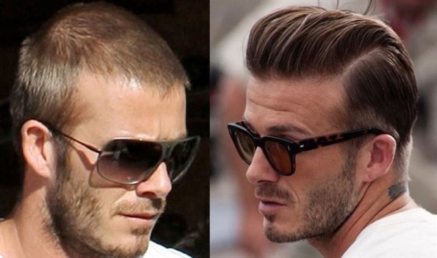 تجارب زراعة الشعر في تركيا