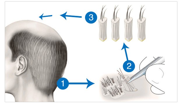 زراعة الشعر في تركيا للنساء