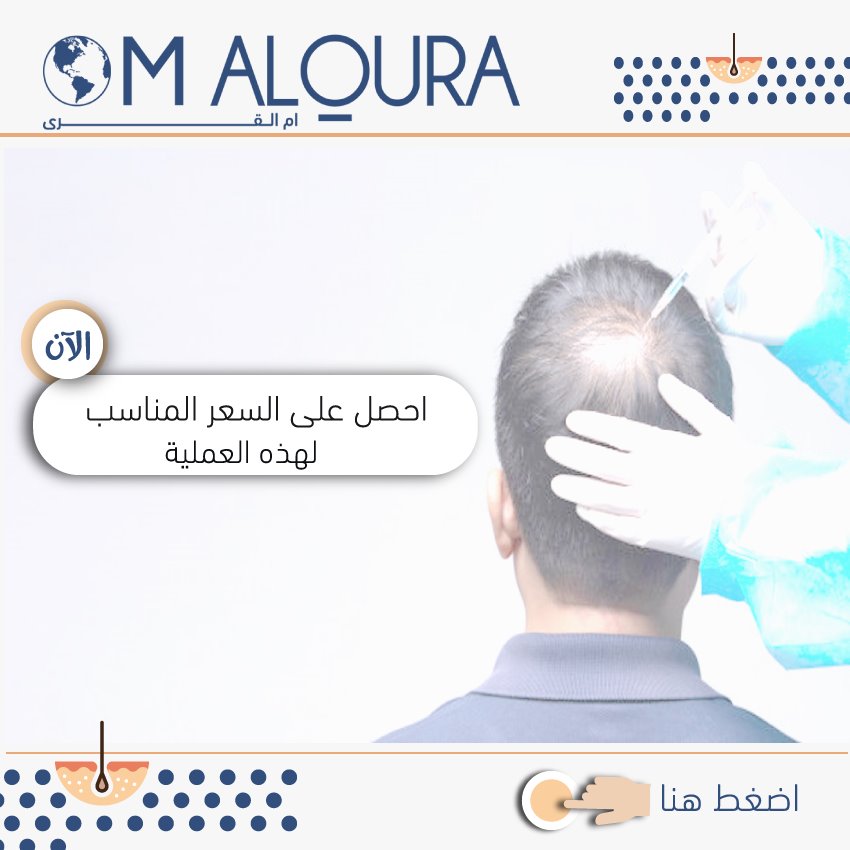 تجربتي مع زراعة الشعر - التقنيات