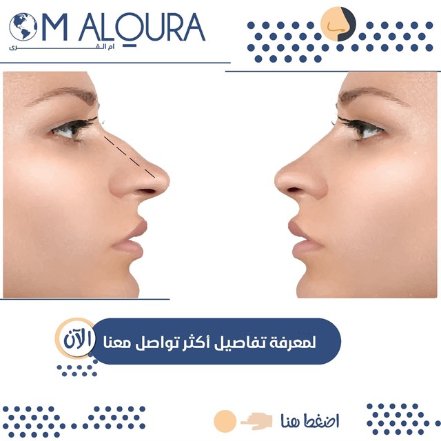 اسعار عمليات تجميل الانف في تركيا
